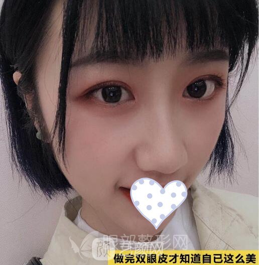 开眼角需要多长时间恢复