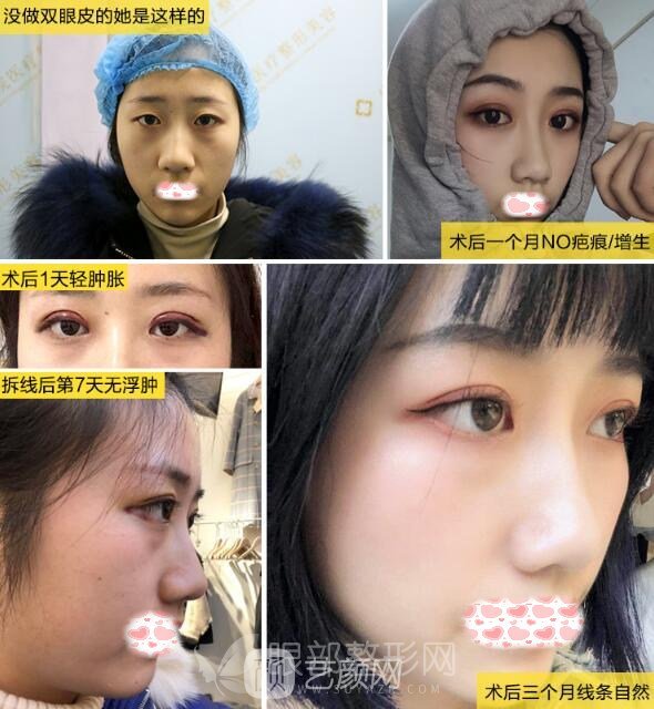 医生告诉我开眼角需要多长时间恢复，我来解答！