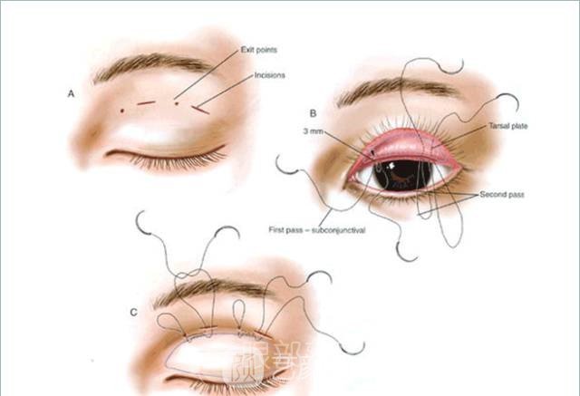 高分子双眼皮轻松让你变成女神,成为人群中较靓的那一个!