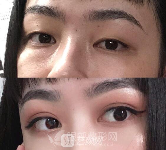 北京做双眼皮手术果好不好  案例