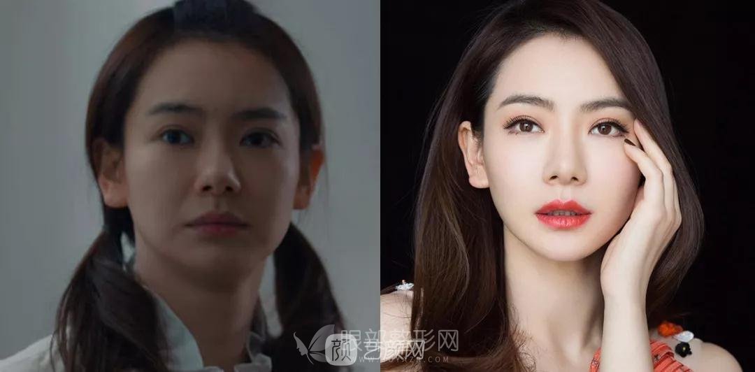 做双眼皮手术怎么选