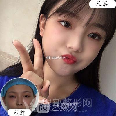 韩式三点定位双眼皮果(图)