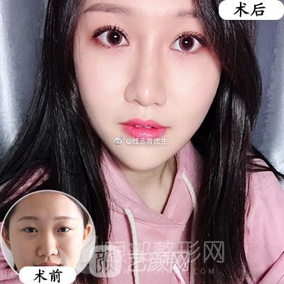 韩式三点定位双眼皮一般多少钱