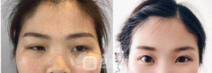 眼部手术的术后现场照片~多方位放大双眼！