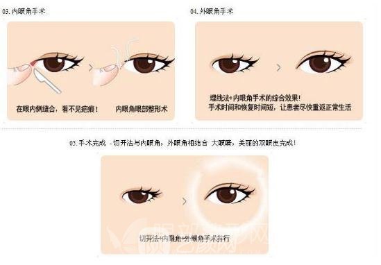 眼部手术的术后现场照片~多方位放大双眼！