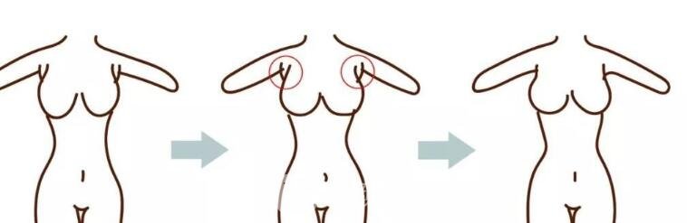 什么叫后天性型副乳?