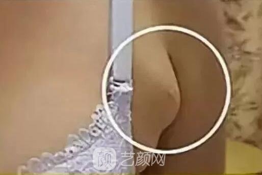 副乳有什么种类?