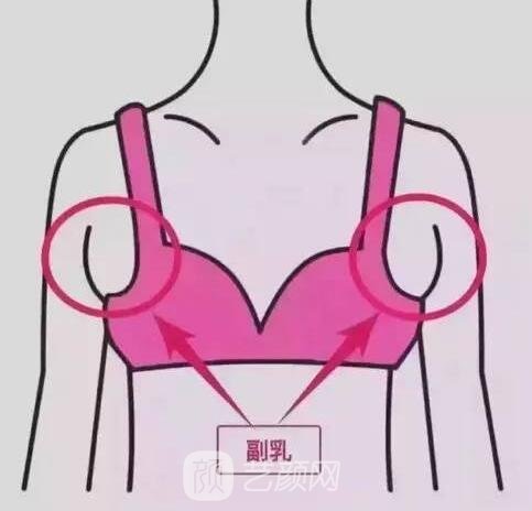 什么叫后天性型副乳?