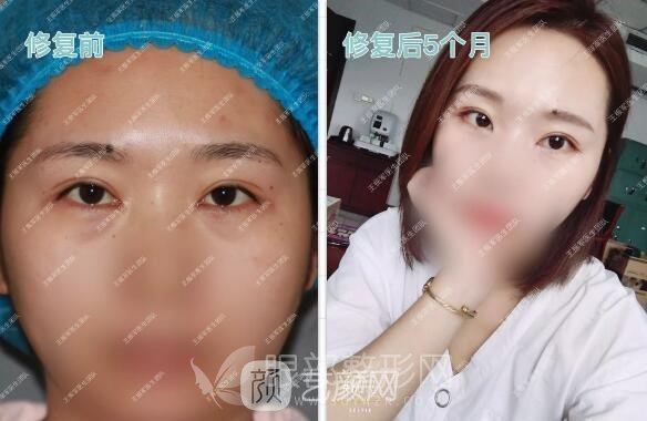 王振军内眼角修复案例