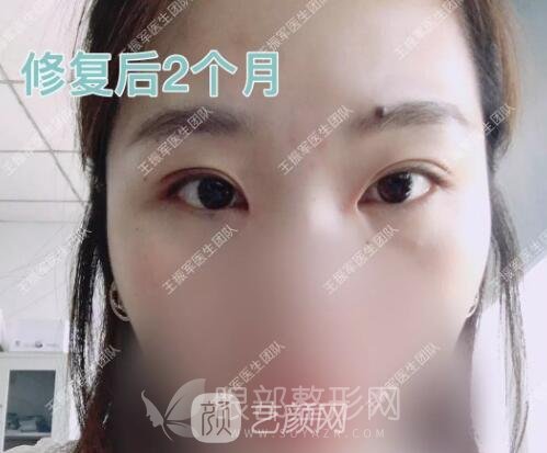王振军眼部修复案例