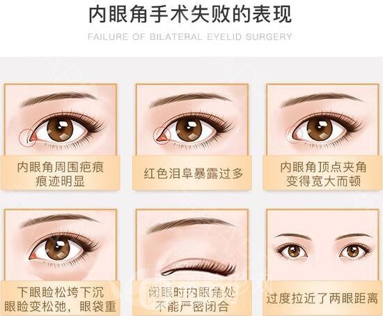 内眼角修复