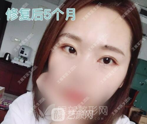 王振军眼修复案例