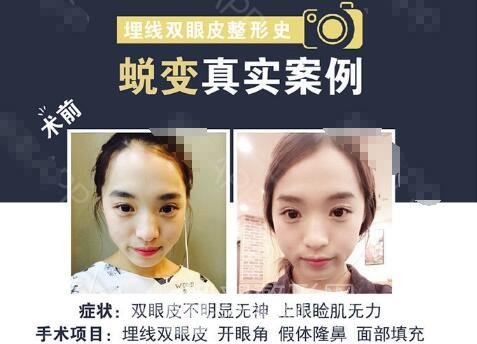 韩国割双眼皮多少钱