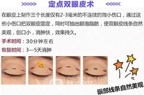 拉双眼皮手术，韩式定点方法好不好