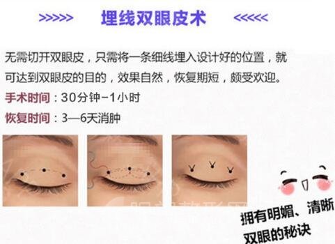 拉双眼皮手术，埋线方法好不好