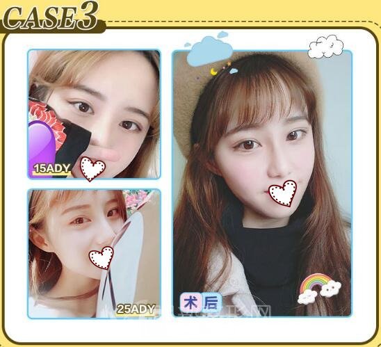 拉双眼皮术后果参考