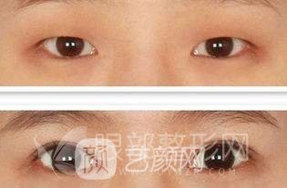 拉双眼皮手术果怎么样