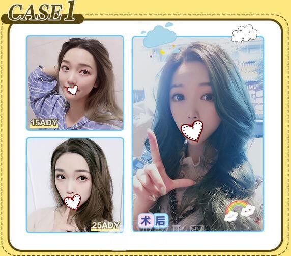 拉双眼皮案例分享