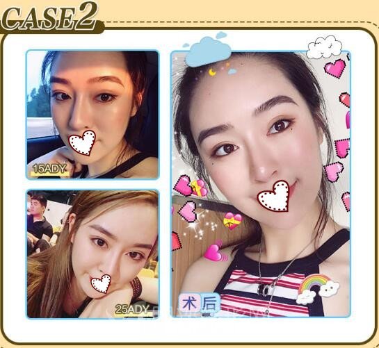 拉双眼皮埋线术后果