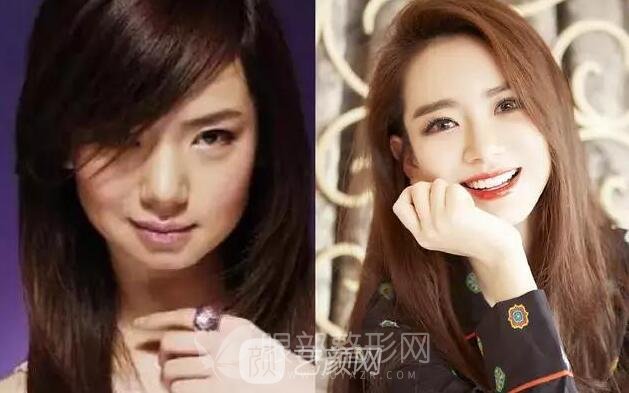 做一个拉双眼皮手术 颜值提高