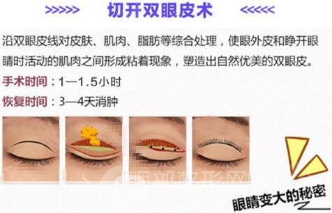 拉双眼皮全切多少钱