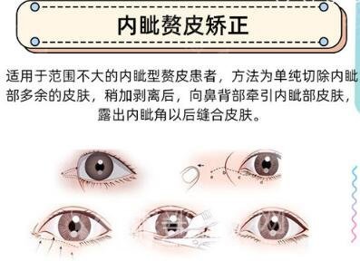 开眼角手术原理