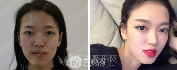 开眼角手术果图