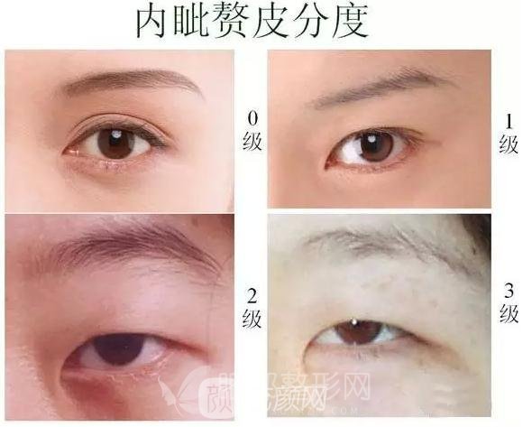内眦赘皮严重程度