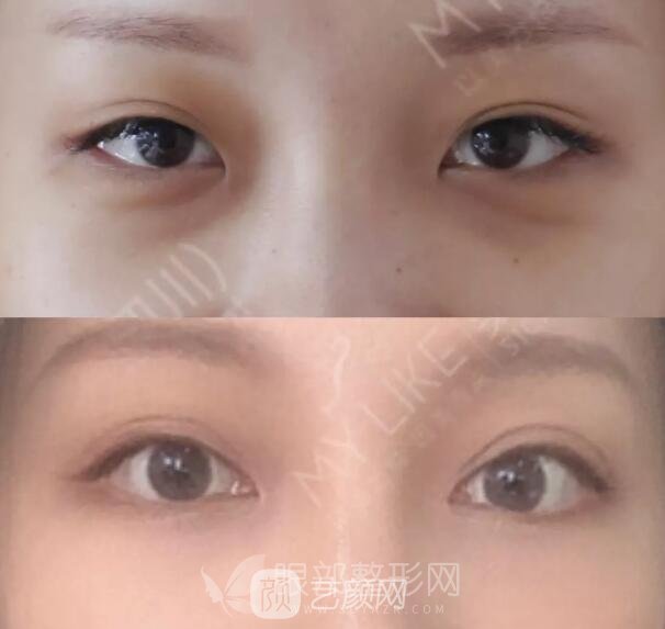 开眼角手术果
