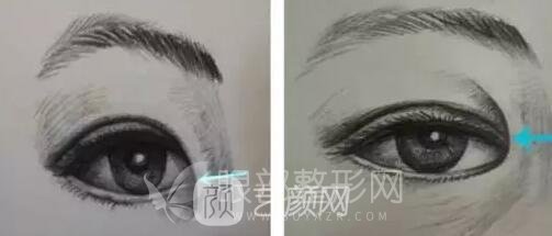 内眦赘皮矫正术