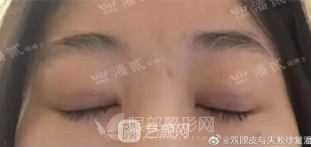 韩式微创开眼角术后果反馈