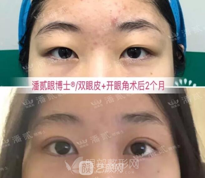 韩式微创开眼角果图 术前术后