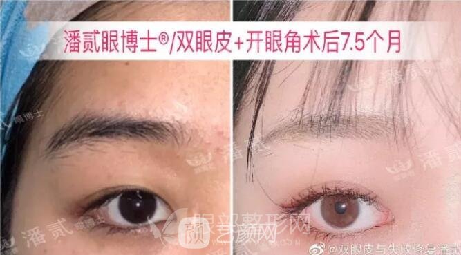 韩式微创开眼角手术果参考