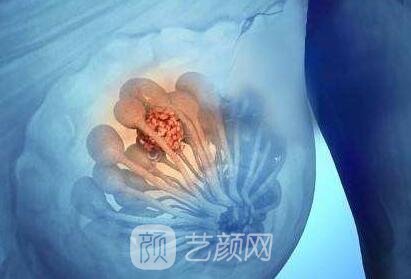 乳腺结节会癌变吗？得了乳腺结节该怎么办？