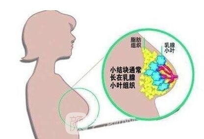 乳腺结节分两大类，不一定是乳房疾病