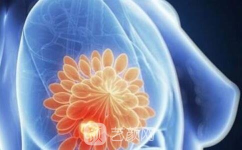 常规体检查出来乳腺结节该怎么办?