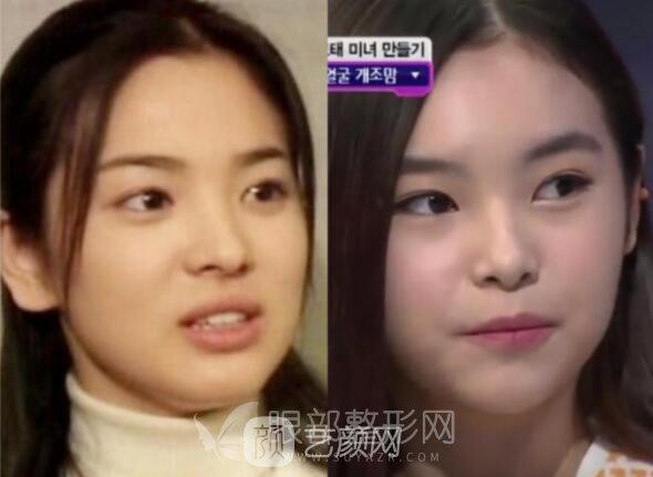 不动刀就能拥有宋慧乔同款双眼皮+下巴？怎么弄