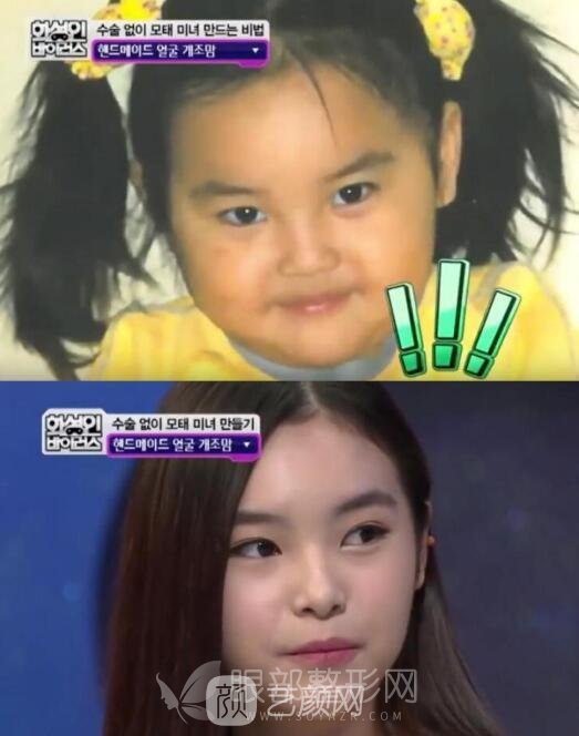 不动刀怎么做双眼皮