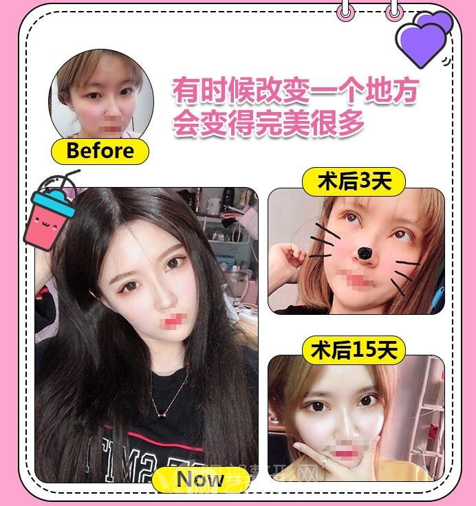 不动刀双眼皮果好不好