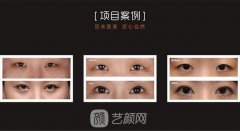 高寿松：请收好这份开眼角后疤痕增生的原因和修复方法~