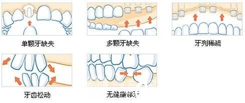 上海薇琳医疗美容医院马晓蓬需要种植的牙齿类型