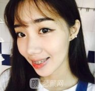 李宇医生技术怎么样？凸嘴矫正案例分享！