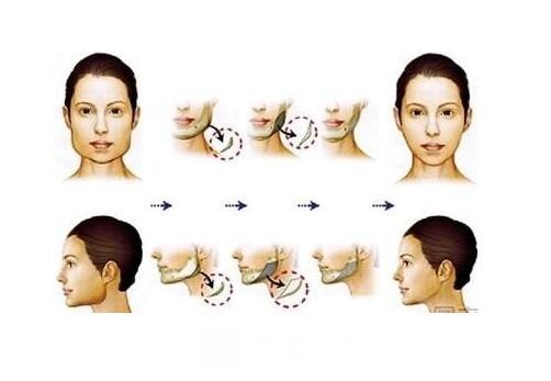 磨腮削骨后遗症有哪些磨腮削骨会特别疼吗
