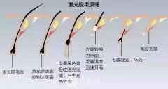 腋窝激光脱毛多少钱？贵吗？2000元阔以做吗？