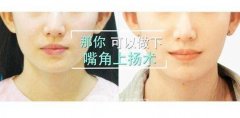 嘴角上扬术费用是多少？嘴角上扬整形价格多少钱？