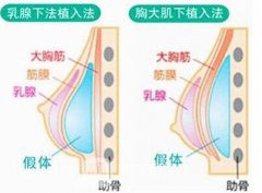曼托隆胸价格是多少？价格贵吗？