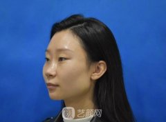 北京韩式耳软骨隆鼻果确实不错，自然而且也没有痕迹