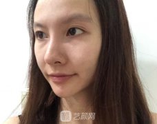 仅仅一个鼻唇沟微整形就拯救了我的颜值，术后很自然