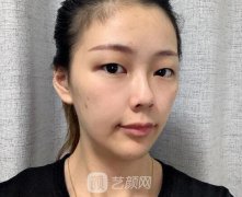 埋线双眼皮可以修复吗？【案例】真是一失足成千古恨！