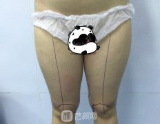 腿部抽脂术后两个多月｜终于拯救了我的大象腿
